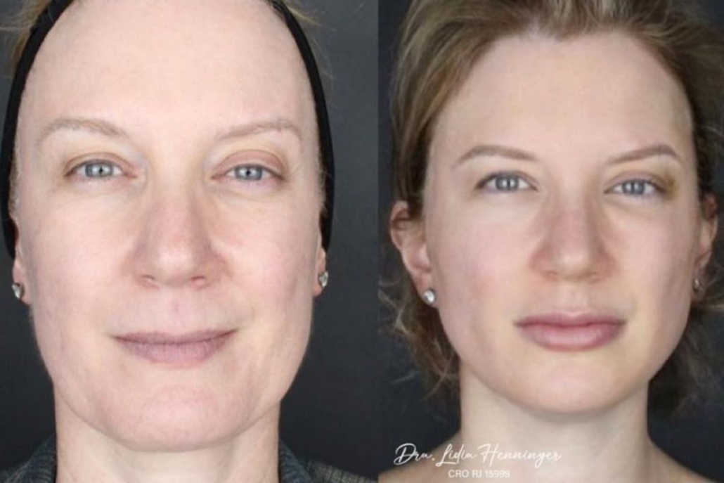 Domine o Lifting Facial com Fios com a Dra. Lidia Henninger