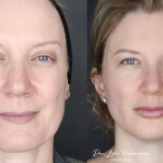 Harmonização Facial Domine o Lifting Facial com Fios com a Dra. Lidia Henninger