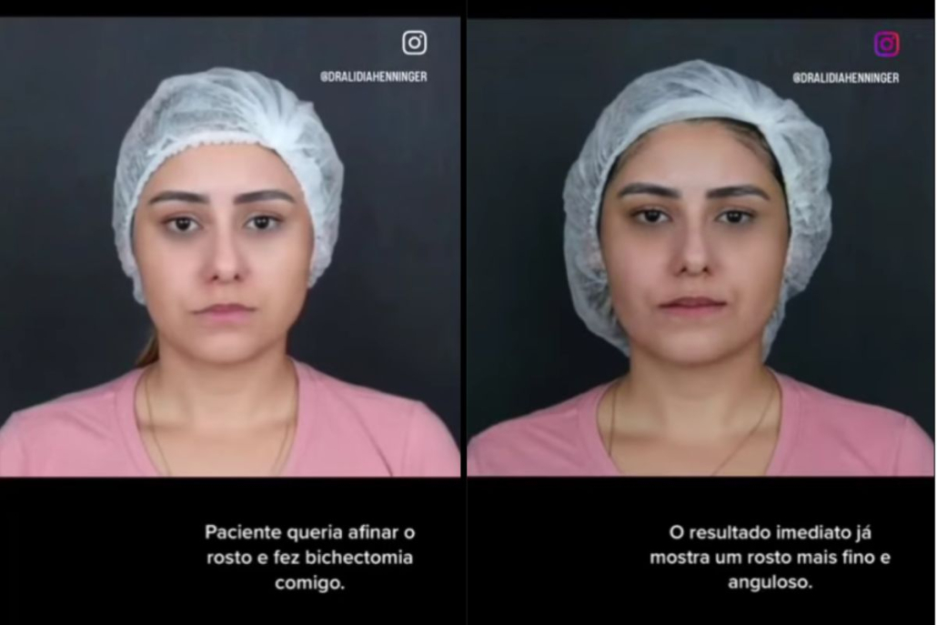 Depoimento de paciente que fez bichectomia: como foi a cirurgia e o resultado imediato