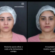 Depoimento de paciente que fez bichectomia: como foi a cirurgia e o resultado imediato