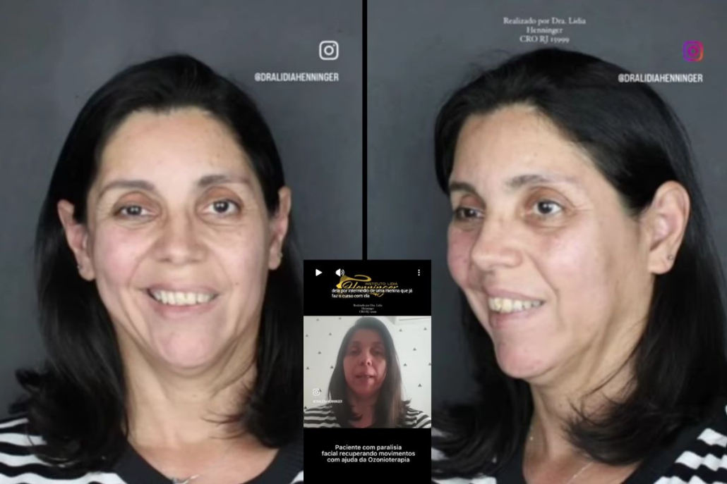 Depoimento de paciente com paralisia facial tratada com ozonioterapia
