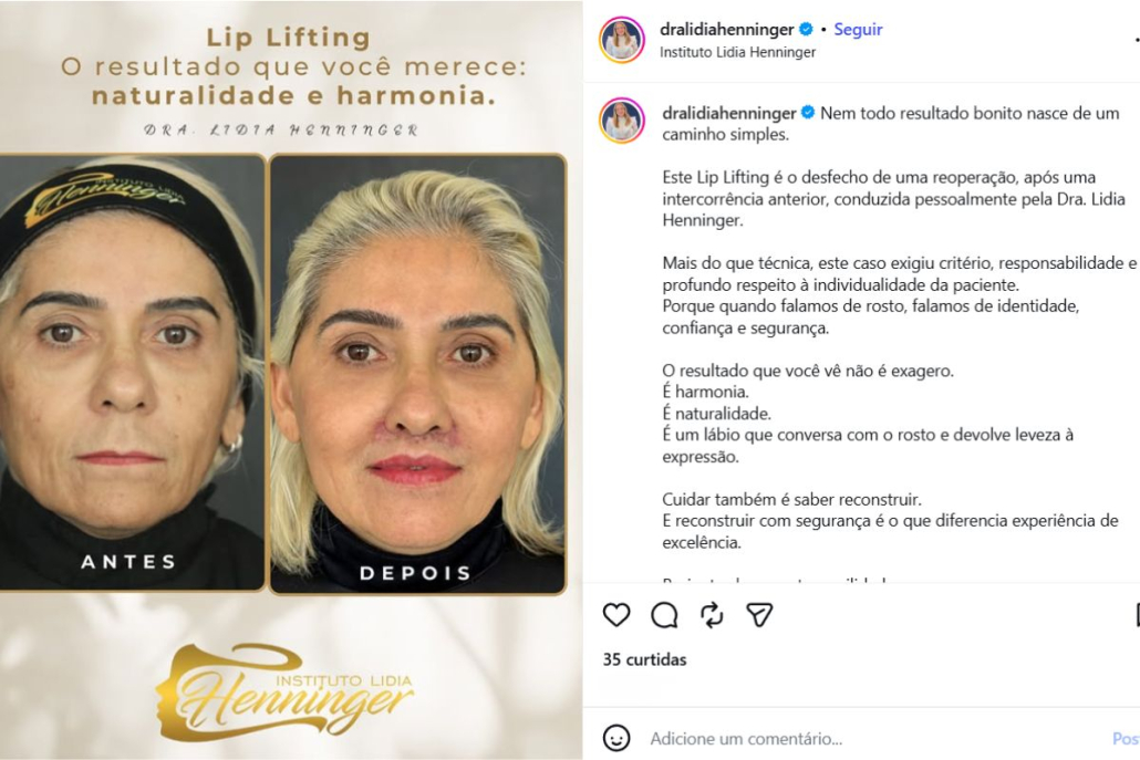 Lip Lift reparador: quando a reoperação é indicada e como buscar um resultado natural com segurança