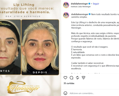 Lip Lift reparador: quando a reoperação é indicada e como buscar um resultado natural com segurança
