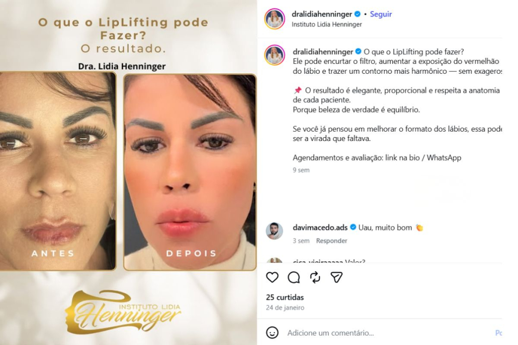 LipLifting: O que ele pode fazer por você?