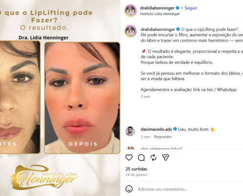 LipLifting: O que ele pode fazer por você?
