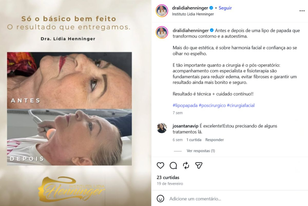 Lipo de papada antes e depois: como o contorno facial e a autoestima podem mudar