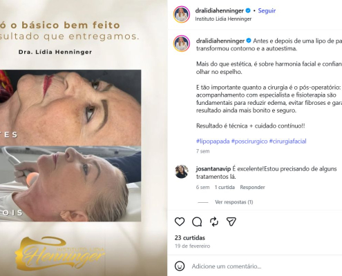 Lipo de papada antes e depois: como o contorno facial e a autoestima podem mudar