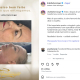 Lipo de papada antes e depois: como o contorno facial e a autoestima podem mudar