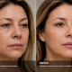 Blefaroplastia: quando o olhar cansado deixa de ser idade e passa a ser anatomia