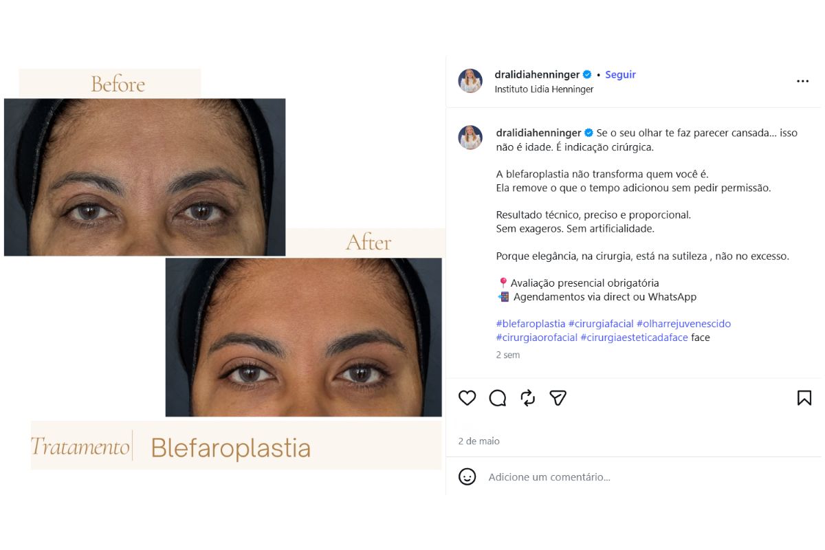 Benefícios funcionais e estéticos da blefaroplastia