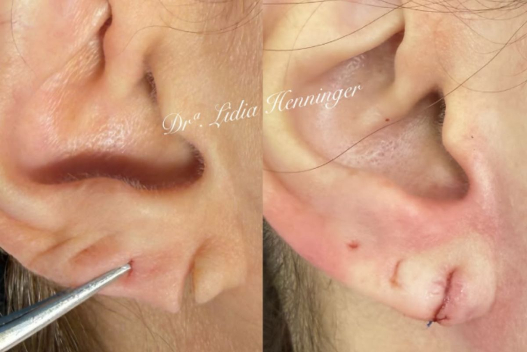 Lobuloplastia: como a reconstrução do lóbulo da orelha devolve estética, função e autoestima