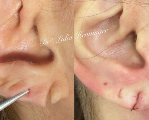 Lobuloplastia: como a reconstrução do lóbulo da orelha devolve estética, função e autoestima