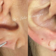 Lobuloplastia: como a reconstrução do lóbulo da orelha devolve estética, função e autoestima